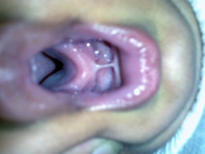 Tight Frenulum causing tongue tie