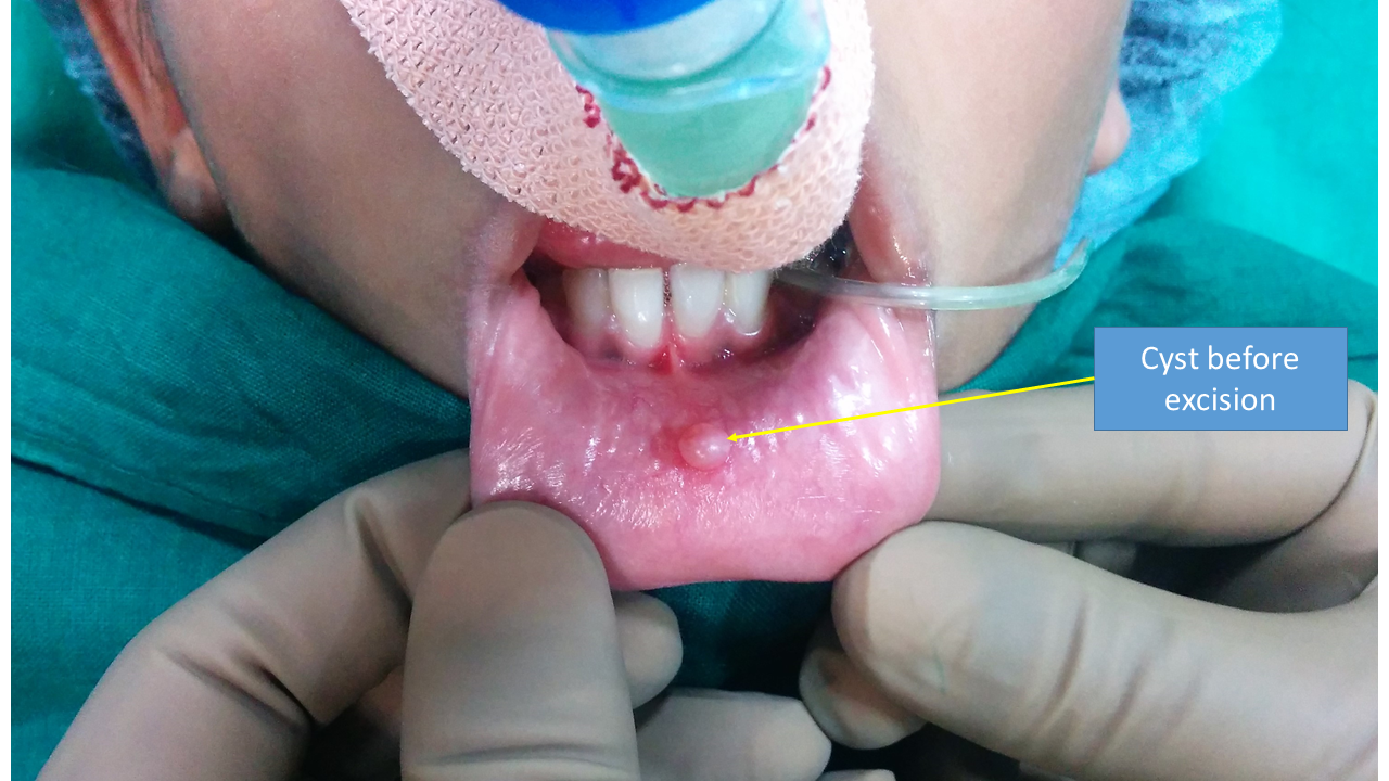 Mucoceles – Swelling On Inner Side Of The Lip