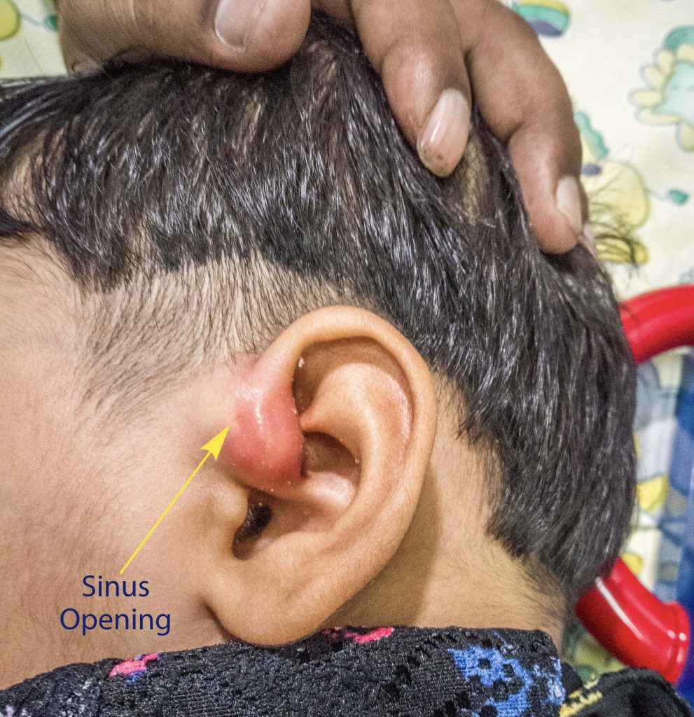 Preauricular Abscess