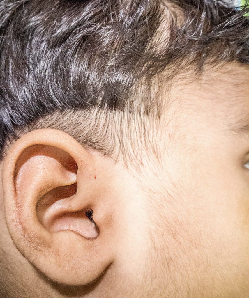 A hole near the ear! aka Preauricular Sinus – The Gentle Surgeon